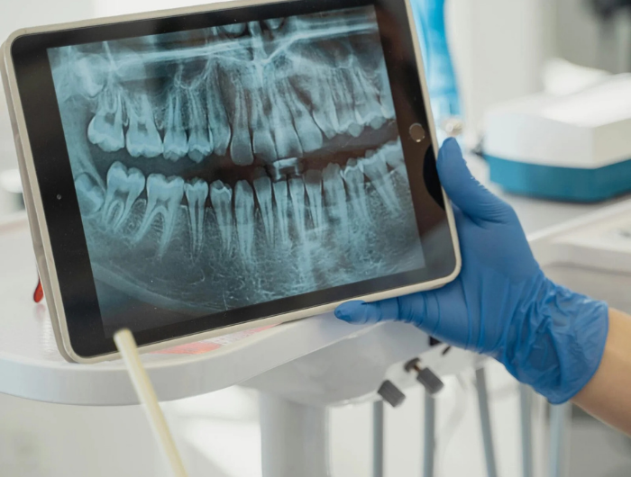 Implantes dentários: a solução definitiva para quem perdeu um ou mais dentes!