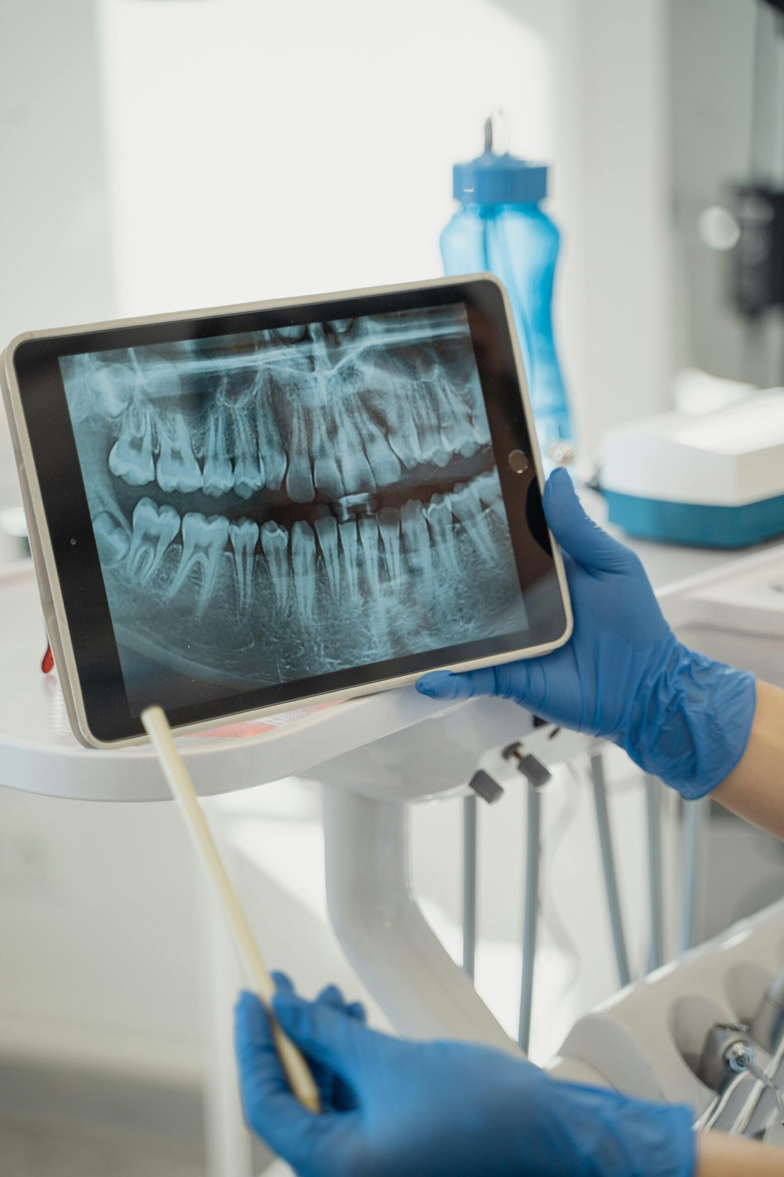 Implantes dentários: a solução definitiva para quem perdeu um ou mais dentes!